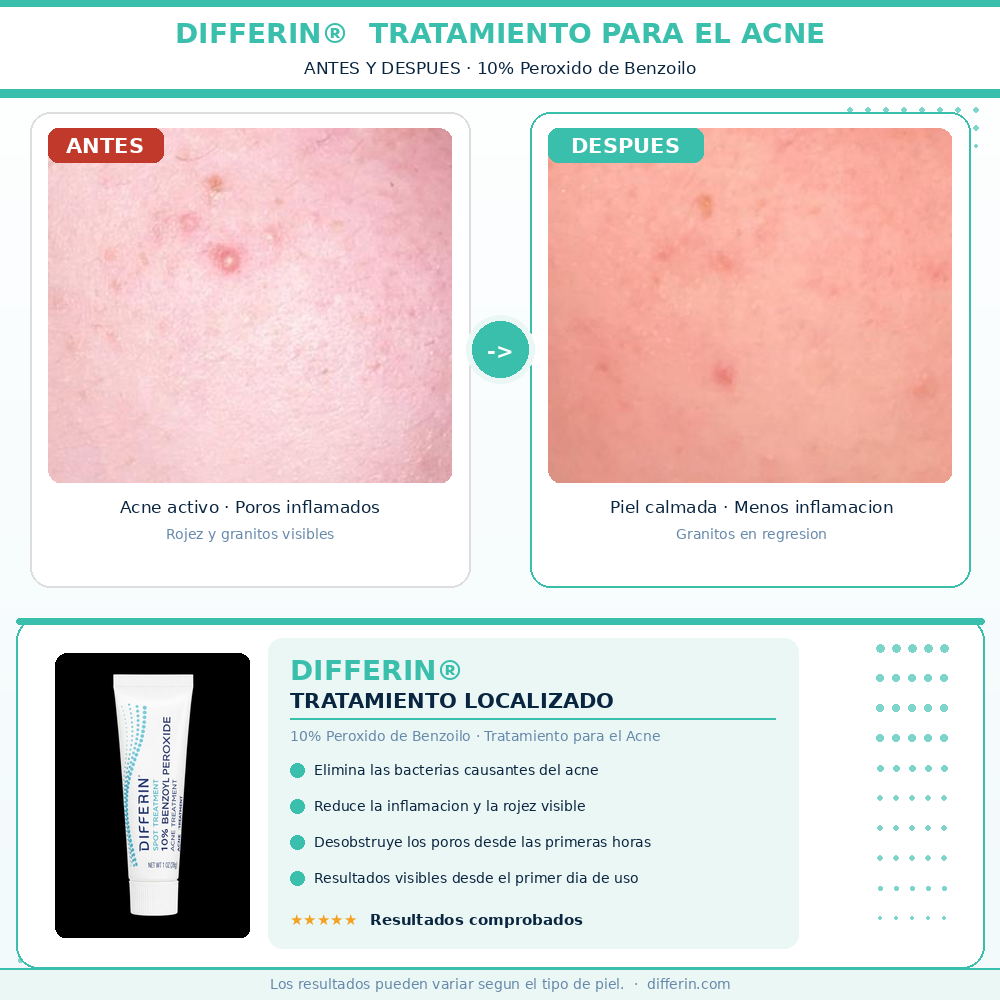PREMIUN Antiacné: DIFFERIN MAX.Potencia